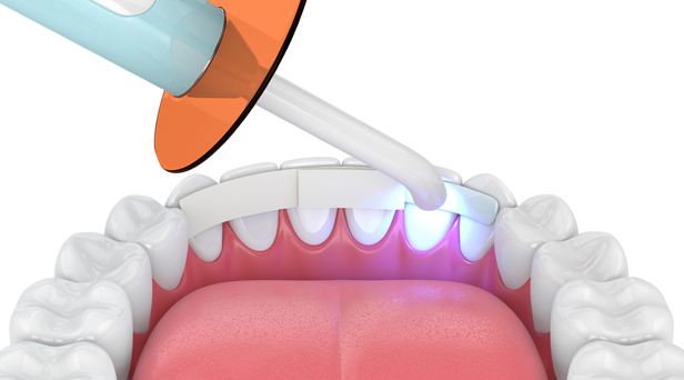 How To Care For Bonded Teeth