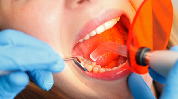 Teeth Bonding Consultation