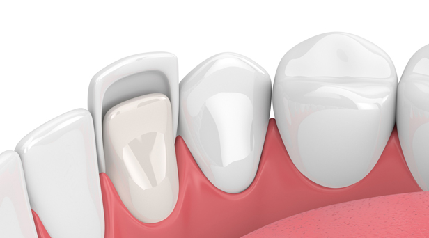 What Exactly Are Dental Veneers