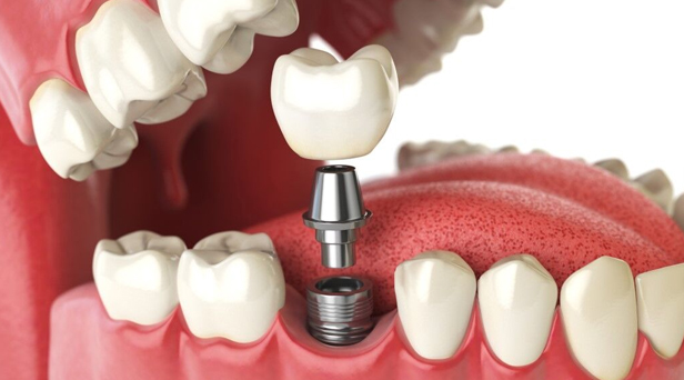What Makes You A Candidate For Dental Implants