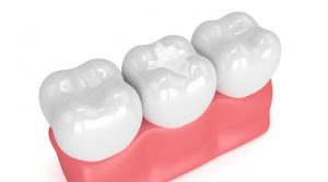 Who Is A Good Candidate For Dental Sealants