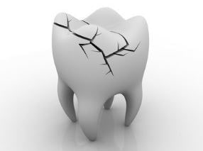 Fusion Dental Care (raleigh, Nc) Render Of A Cracked Tooth