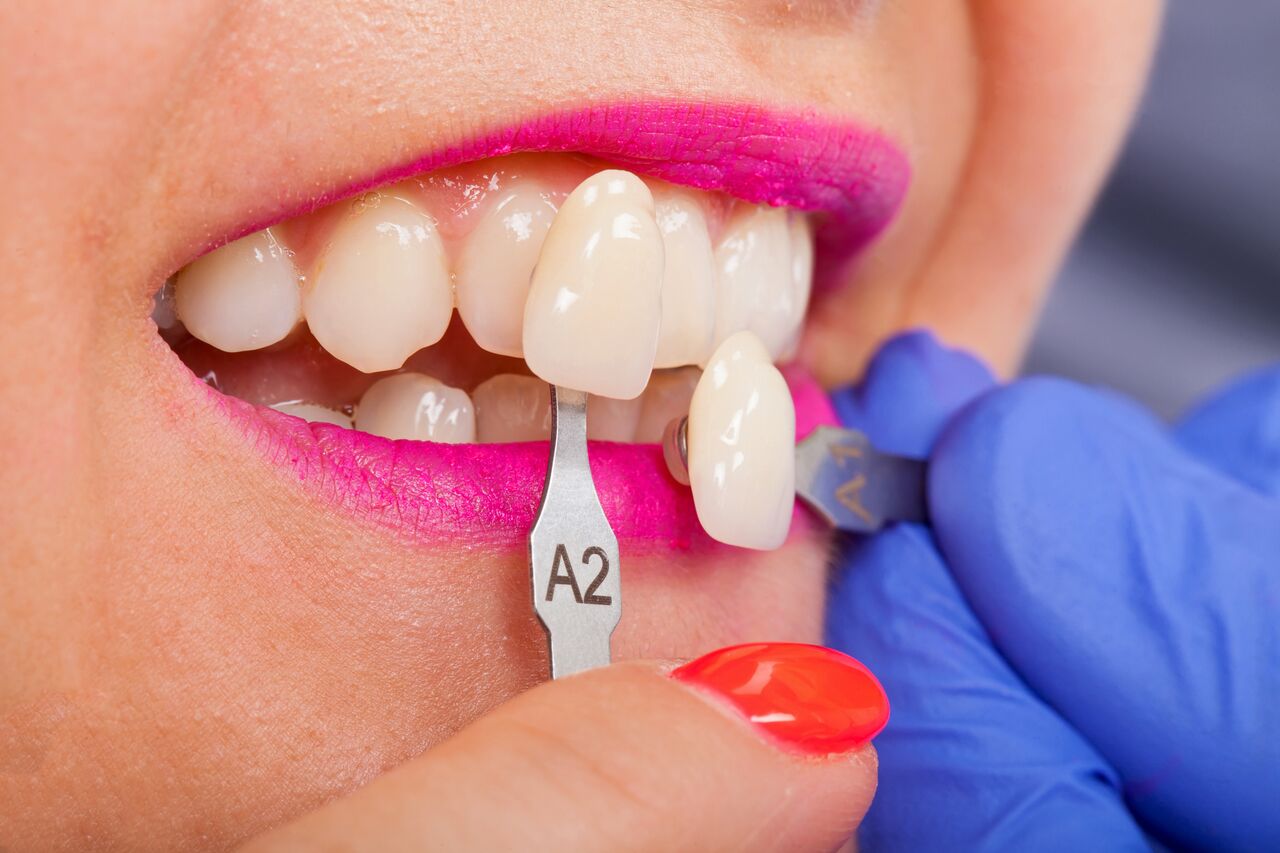 Fusion Dental Care (raleigh, Nc) Veneers
