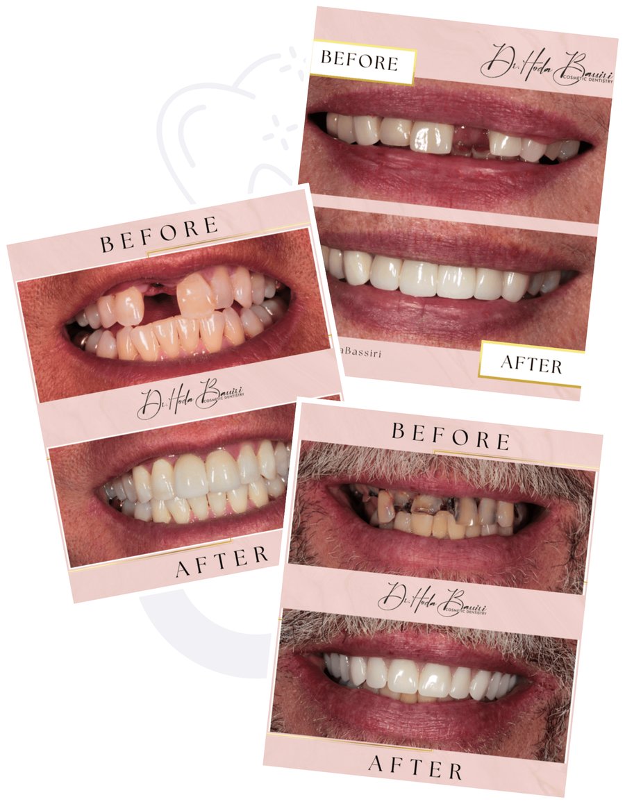 Before and after photos of three dental implant cases treated by Dr. Hoda Bassiri at Fusion Dental Care in Raleigh