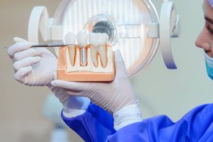 Dentist at Fusion Dental Care in Raleigh holding a dental implant model